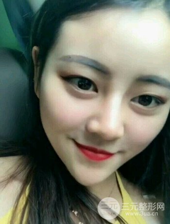 西安切开双眼皮开眼角手术案例恢复过程图分享