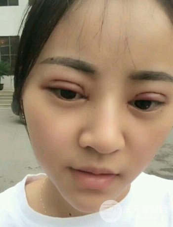 西安切开双眼皮开眼角手术案例恢复过程图分享
