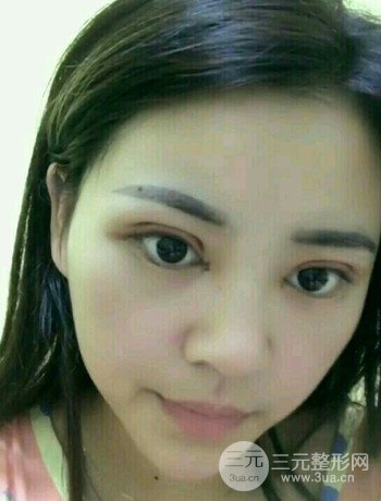 西安切开双眼皮开眼角手术案例恢复过程图分享