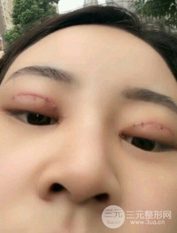 西安切开双眼皮开眼角手术案例恢复过程图分享