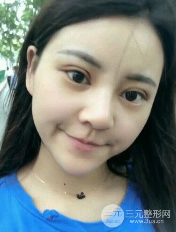 西安切开双眼皮开眼角手术案例恢复过程图分享