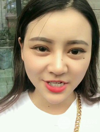 西安切开双眼皮开眼角手术案例恢复过程图分享