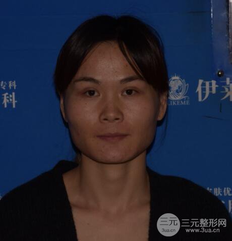 磨骨瘦脸(下颌角切除)恢复过程及前后对比照片