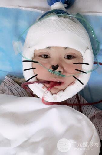 磨骨瘦脸(下颌角切除)恢复过程及前后对比照片