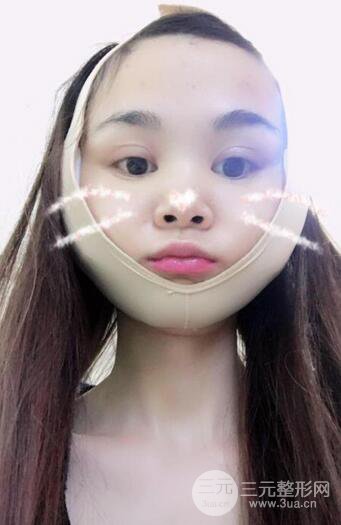 磨骨瘦脸(下颌角切除)恢复过程及前后对比照片