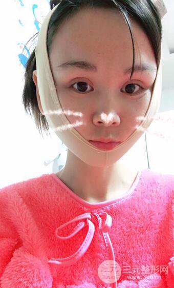 磨骨瘦脸(下颌角切除)恢复过程及前后对比照片