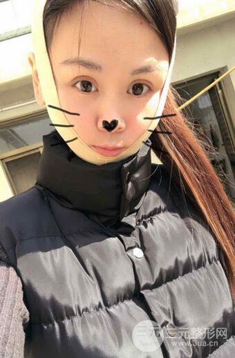 磨骨瘦脸(下颌角切除)恢复过程及前后对比照片