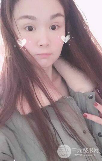 磨骨瘦脸(下颌角切除)恢复过程及前后对比照片