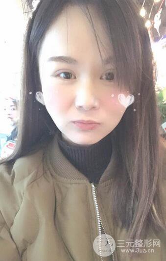 磨骨瘦脸(下颌角切除)恢复过程及前后对比照片