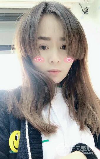 磨骨瘦脸(下颌角切除)恢复过程及前后对比照片