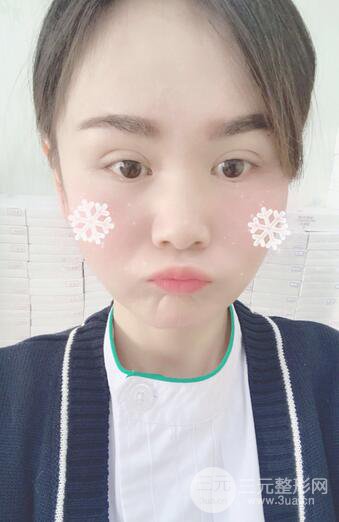 磨骨瘦脸(下颌角切除)恢复过程及前后对比照片