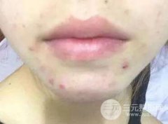 果酸换肤好吗？果酸换肤几次后有果？