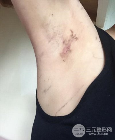 假体隆胸手术恢复记录，丰满大胸不是梦