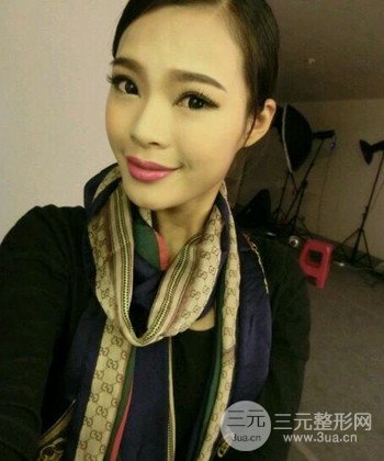 模特做隆鼻整形真实日记分享，附上恢复过程图