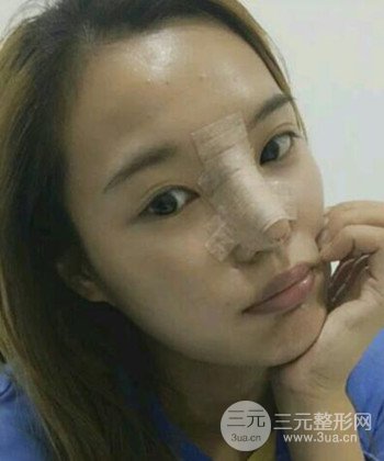 模特做隆鼻整形真实日记分享，附上恢复过程图