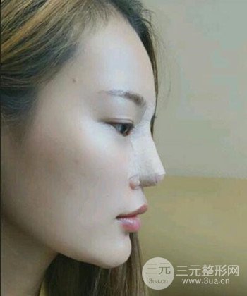 模特做隆鼻整形真实日记分享，附上恢复过程图