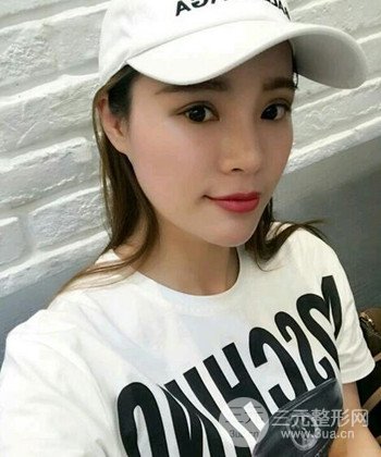 模特做隆鼻整形真实日记分享，附上恢复过程图