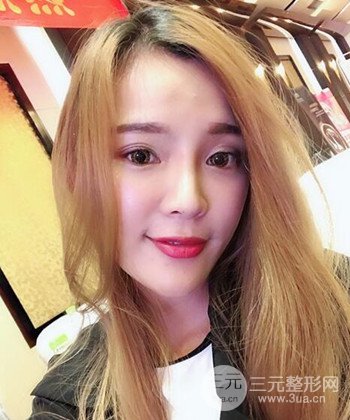 模特做隆鼻整形真实日记分享，附上恢复过程图