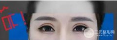 成功的双眼皮手术是怎样的？案例图片大全分享