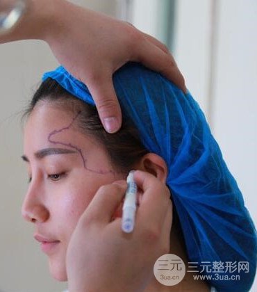 网络主播做自体脂肪丰太阳穴真实案例分享，果杠杠的