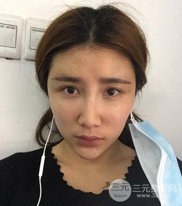 网络主播做自体脂肪丰太阳穴真实案例分享，果杠杠的