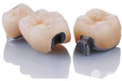 烤瓷牙的种类和价格