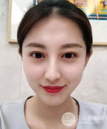 苏州切开双眼皮恢复果大分享，变化不止一点点