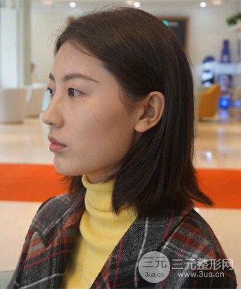 苏州切开双眼皮恢复果大分享，变化不止一点点