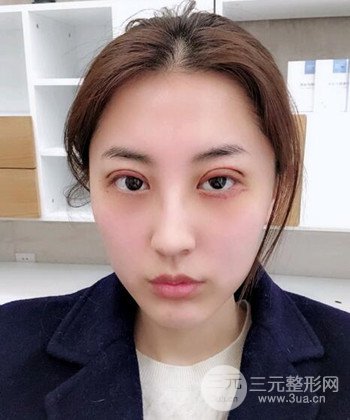 苏州切开双眼皮恢复果大分享，变化不止一点点