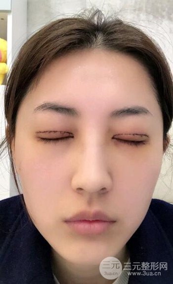 苏州切开双眼皮恢复果大分享，变化不止一点点