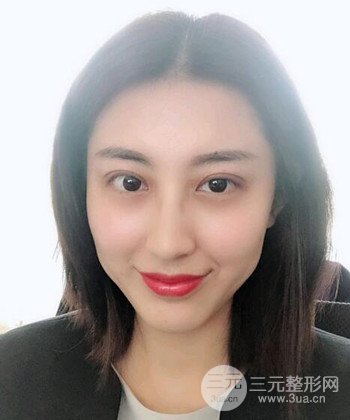苏州切开双眼皮恢复果大分享，变化不止一点点