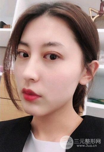 苏州切开双眼皮恢复果大分享，变化不止一点点
