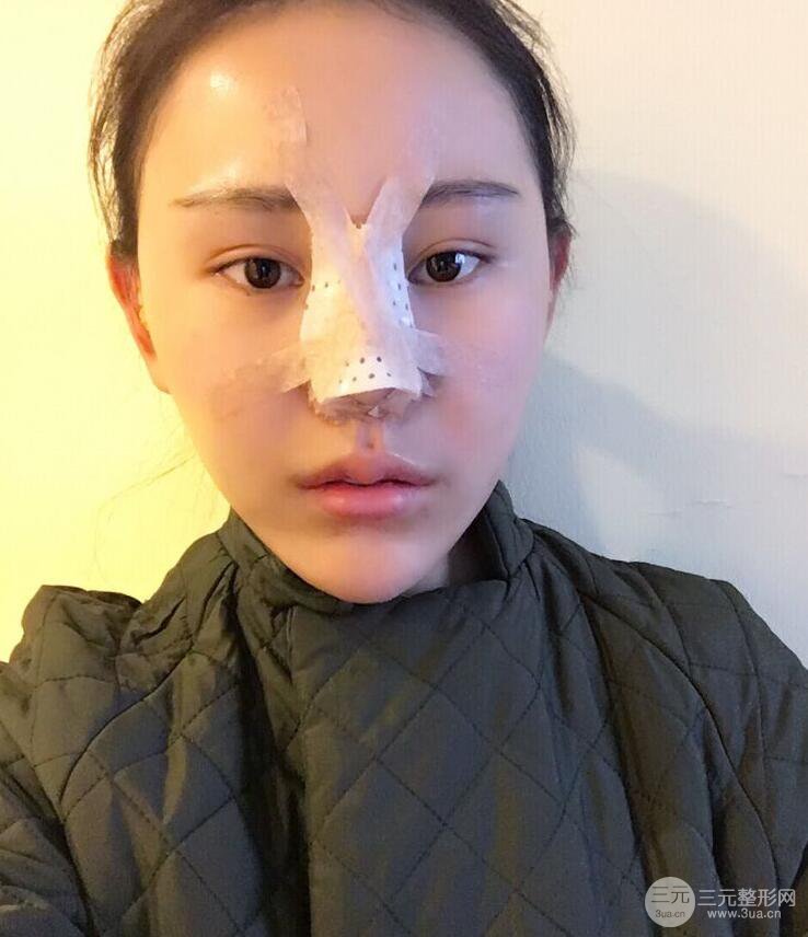 鼻部手术图片隆鼻17天恢复期真实案例前后对比照片分享