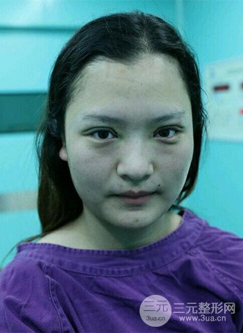 深圳双眼皮正就内双小眼睛，真实案例前后对比照片
