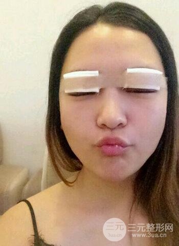 深圳双眼皮正就内双小眼睛，真实案例前后对比照片