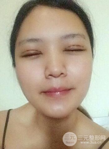 深圳双眼皮正就内双小眼睛，真实案例前后对比照片