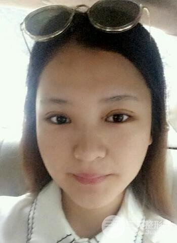 深圳双眼皮正就内双小眼睛，真实案例前后对比照片