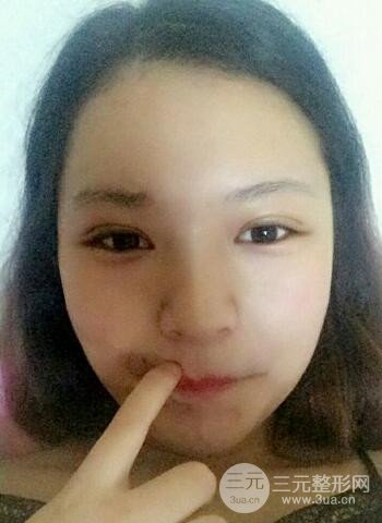 深圳双眼皮正就内双小眼睛，真实案例前后对比照片