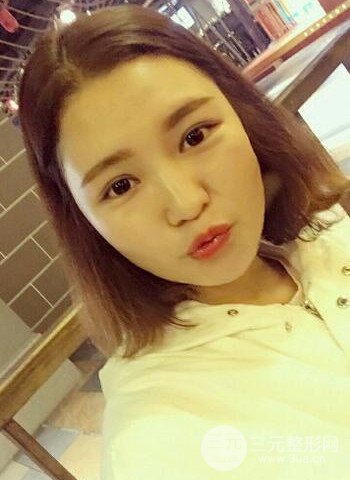 深圳双眼皮正就内双小眼睛，真实案例前后对比照片