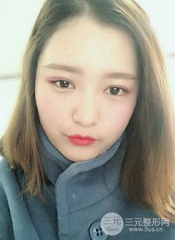 深圳双眼皮正就内双小眼睛，真实案例前后对比照片