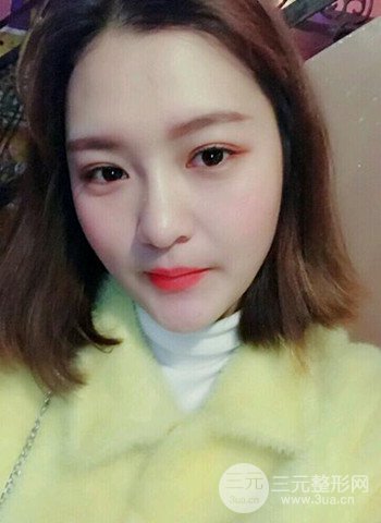 深圳双眼皮正就内双小眼睛，真实案例前后对比照片