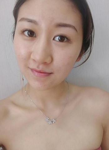广州隆鼻整形真实恢复期图片，拥有精致美鼻不是梦