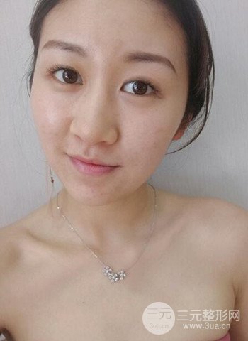 广州隆鼻整形真实恢复期图片，拥有精致美鼻不是梦