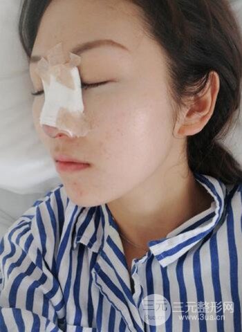广州隆鼻整形真实恢复期图片，拥有精致美鼻不是梦