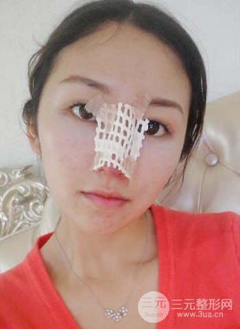 广州隆鼻整形真实恢复期图片，拥有精致美鼻不是梦
