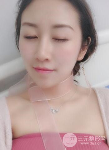 广州隆鼻整形真实恢复期图片，拥有精致美鼻不是梦