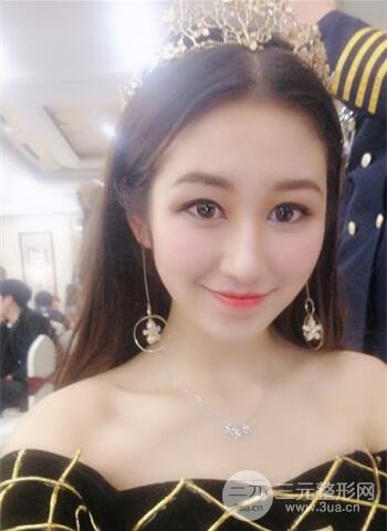 广州隆鼻整形真实恢复期图片，拥有精致美鼻不是梦