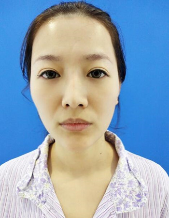 广州隆鼻整形+全脸自体脂肪填充真人案例果分享