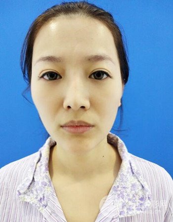 广州隆鼻整形+全脸自体脂肪填充真人案例果分享