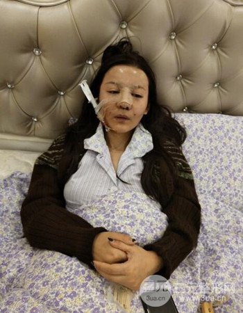 广州隆鼻整形+全脸自体脂肪填充真人案例果分享